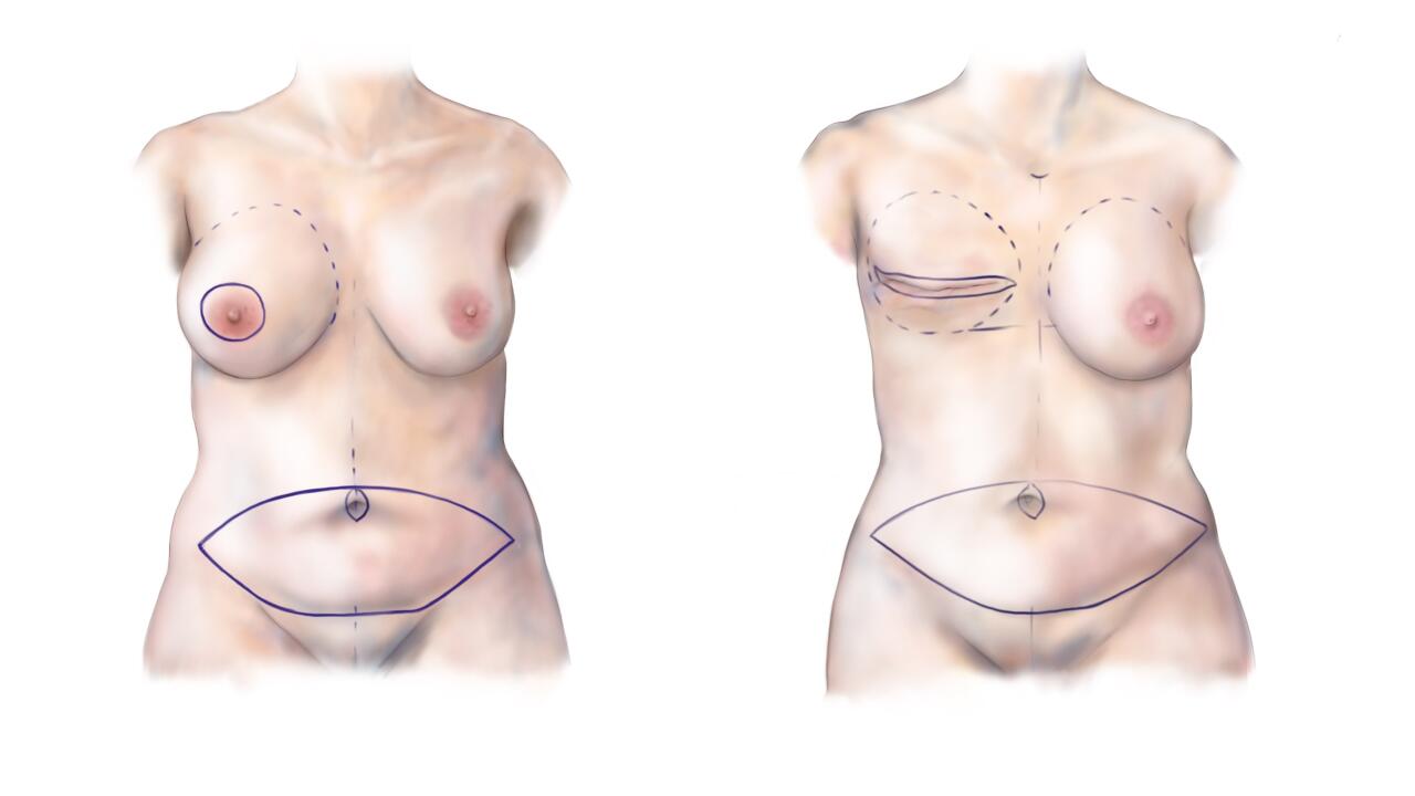 borstreconstructie met DIEP flap techniek, tijdens of na het verwijderen van borst bij borstkankerpatiënten bijvoorbeeld