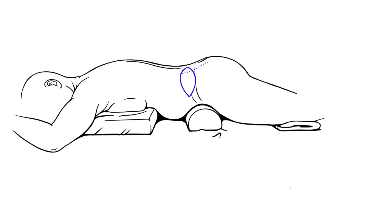 Borstreconstructie: LUMBAR flap om de borst te reconstrueren bij een reconstructie van de borst met eigen huid en vetweefsel