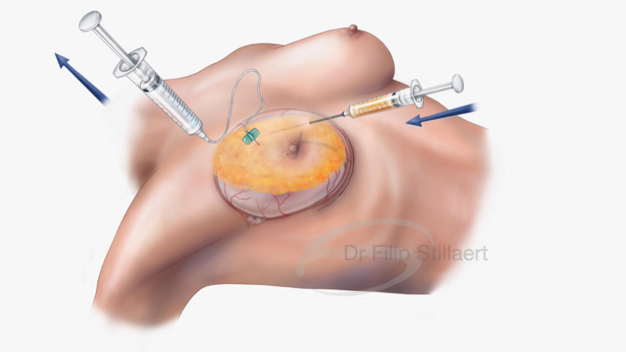 Drie maanden na de eerste lipofilling procedure herhaalt men de lipofilling procedure. Zo bouwt men geleidelijk aan het onderhuidse volume op en begint de borst vorm te krijgen.