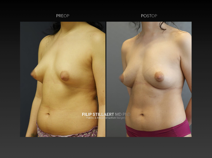 borstvergroting met lipofilling
