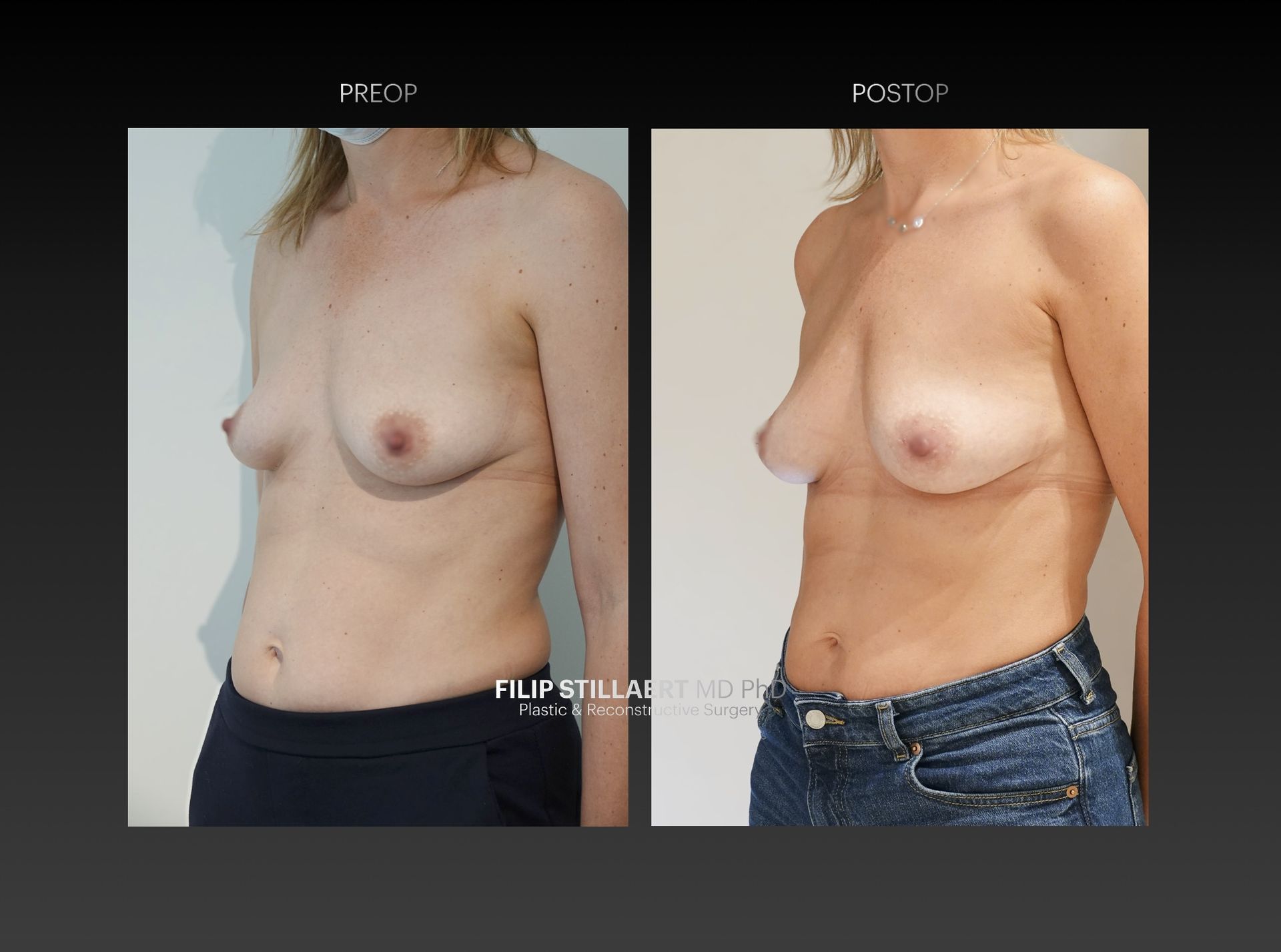 borstvergroting met lipofilling