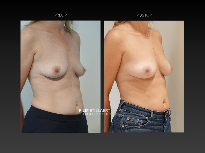 borstvergroting met lipofilling
