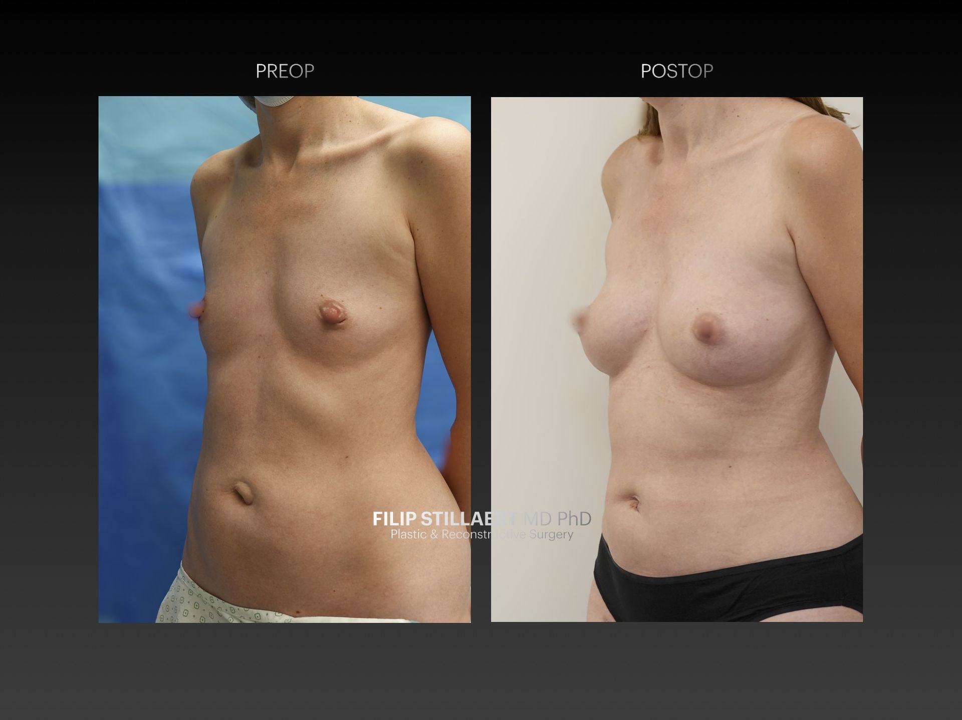 borstvergroting met lipofilling