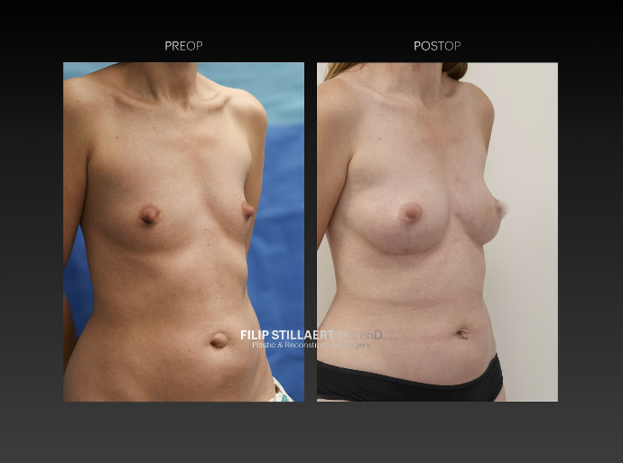 borstvergroting met lipofilling