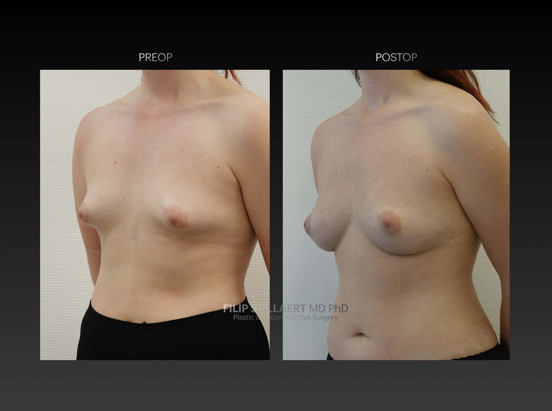borstvergroting met lipofilling