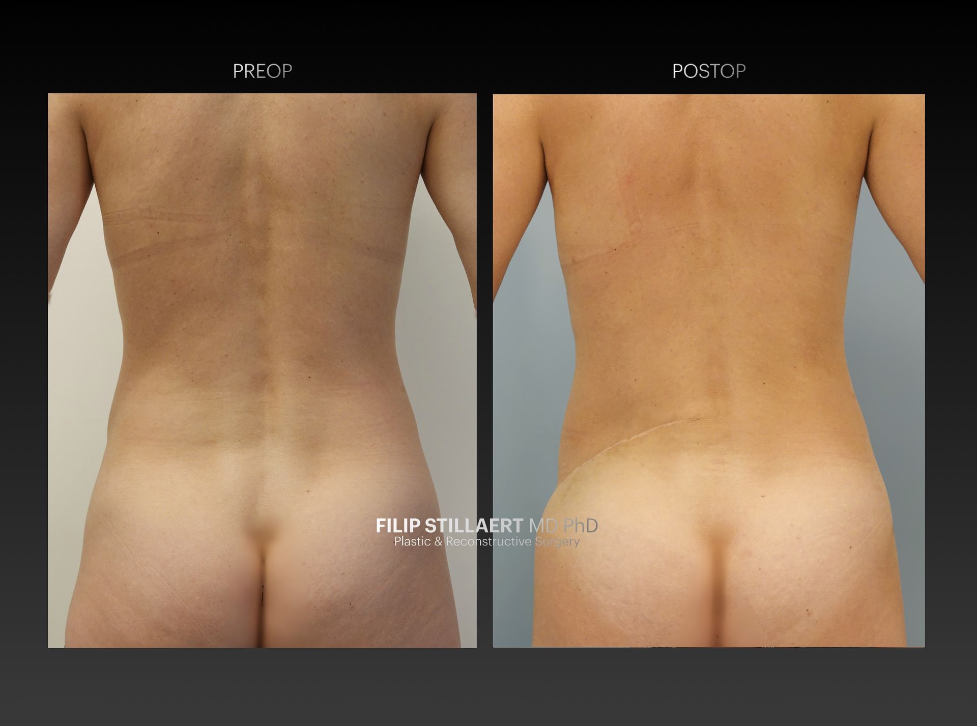 lumbar flap