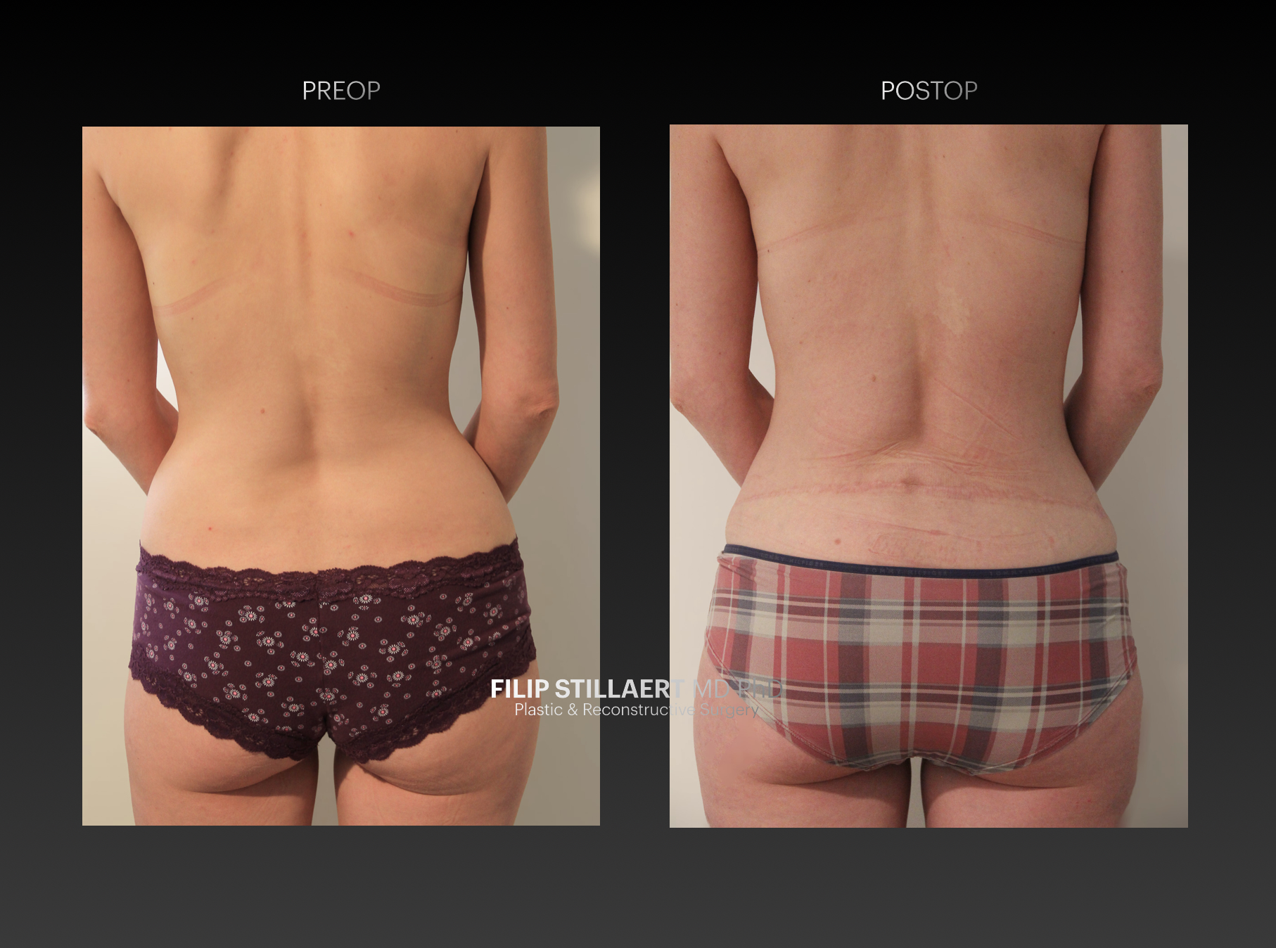 lumbar flap