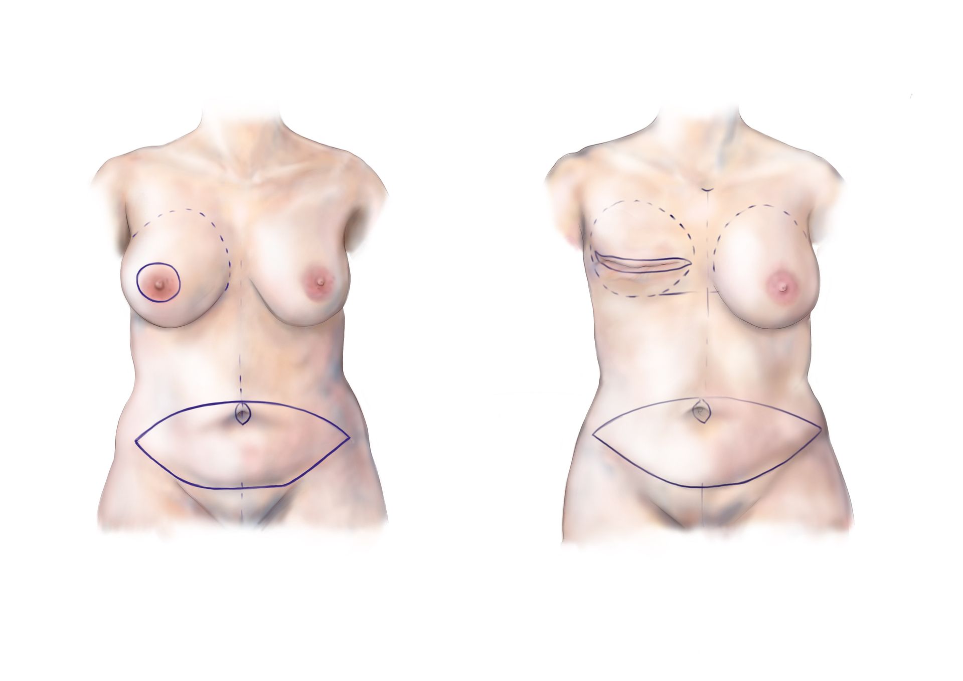 DIEP flap