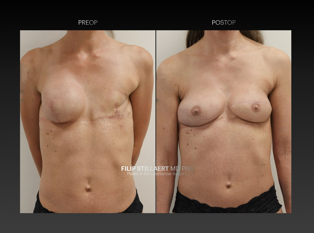sgap flap