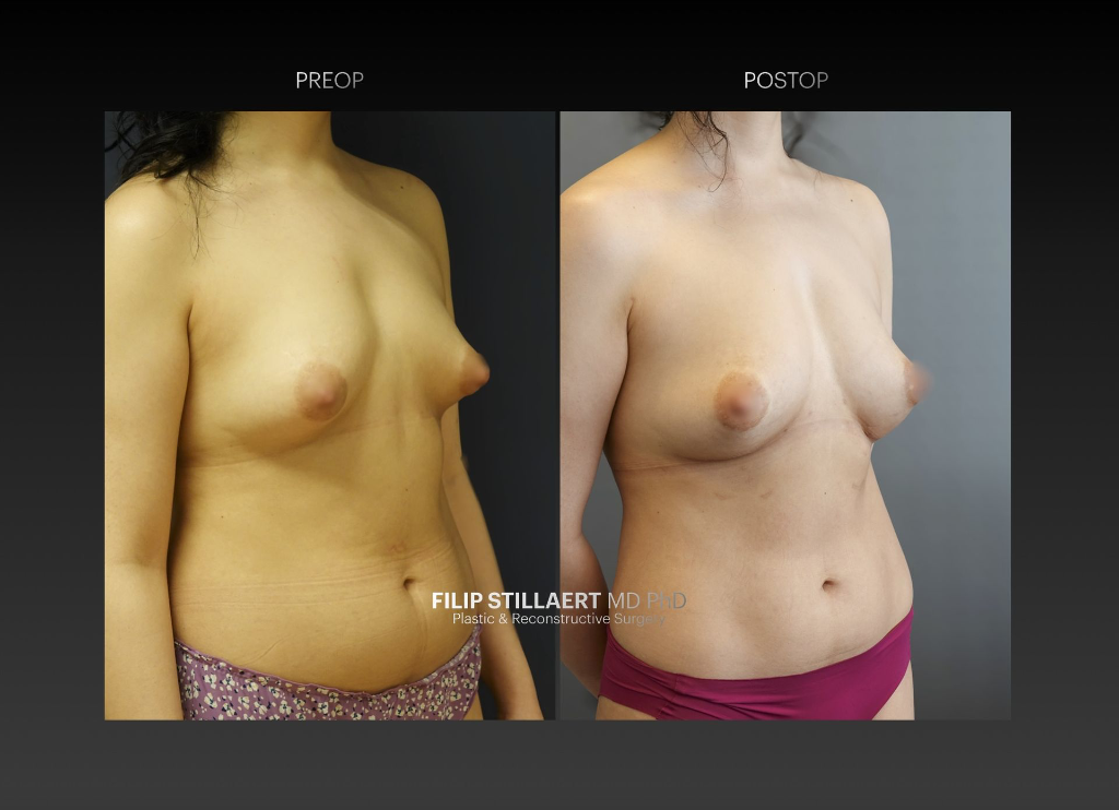 borstvergroting met lipofilling