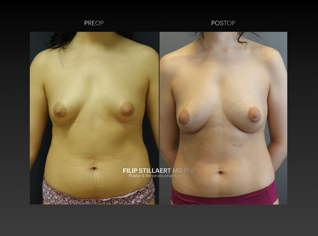 borstvergroting met lipofilling
