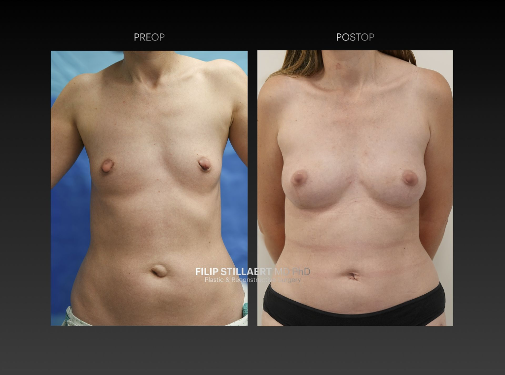 borstvergroting met lipofilling