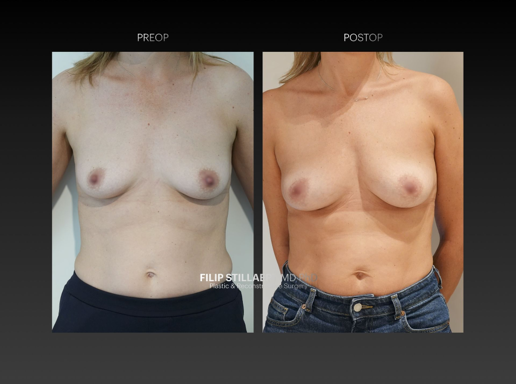 borstvergroting met lipofilling