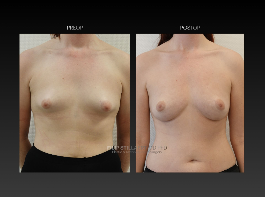 borstvergroting met lipofilling
