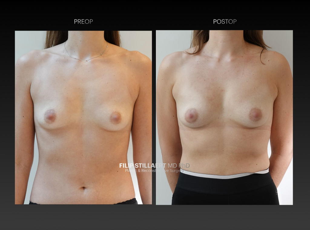 borstvergroting met lipofilling