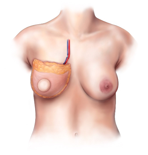 lumbar flap