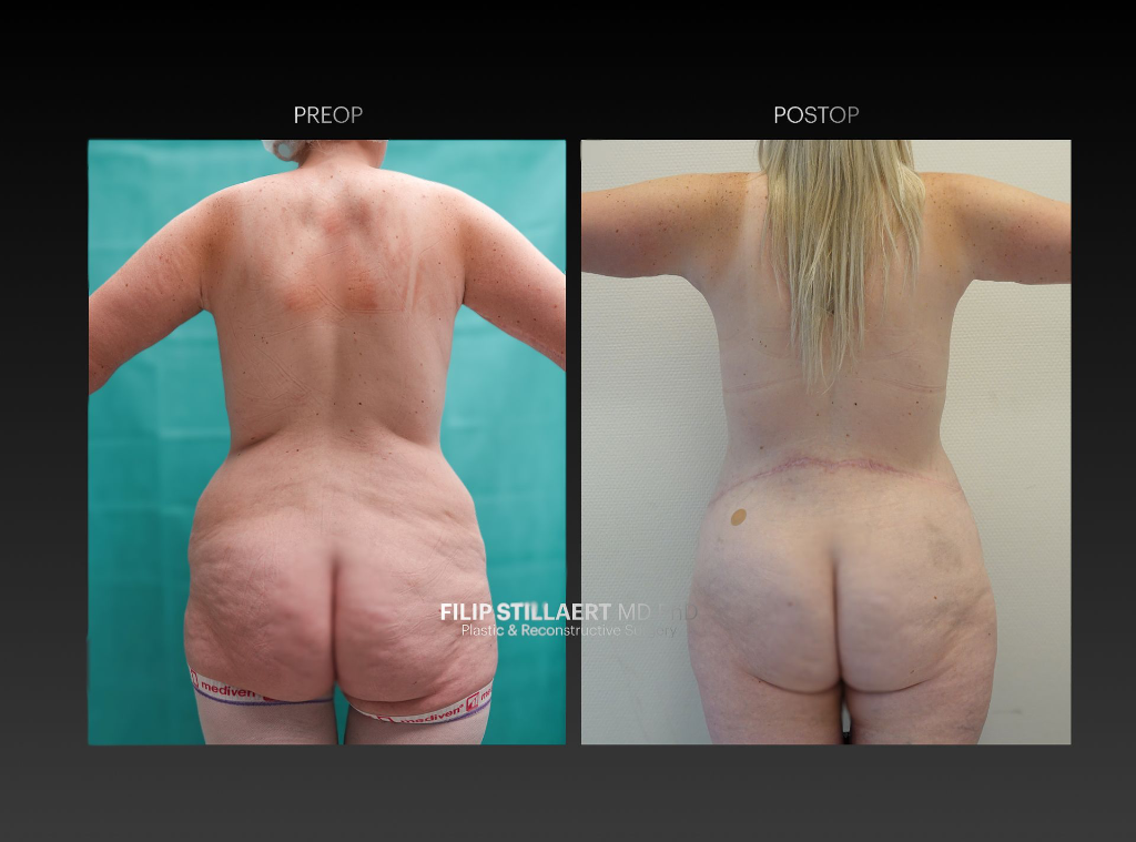 lumbar flap