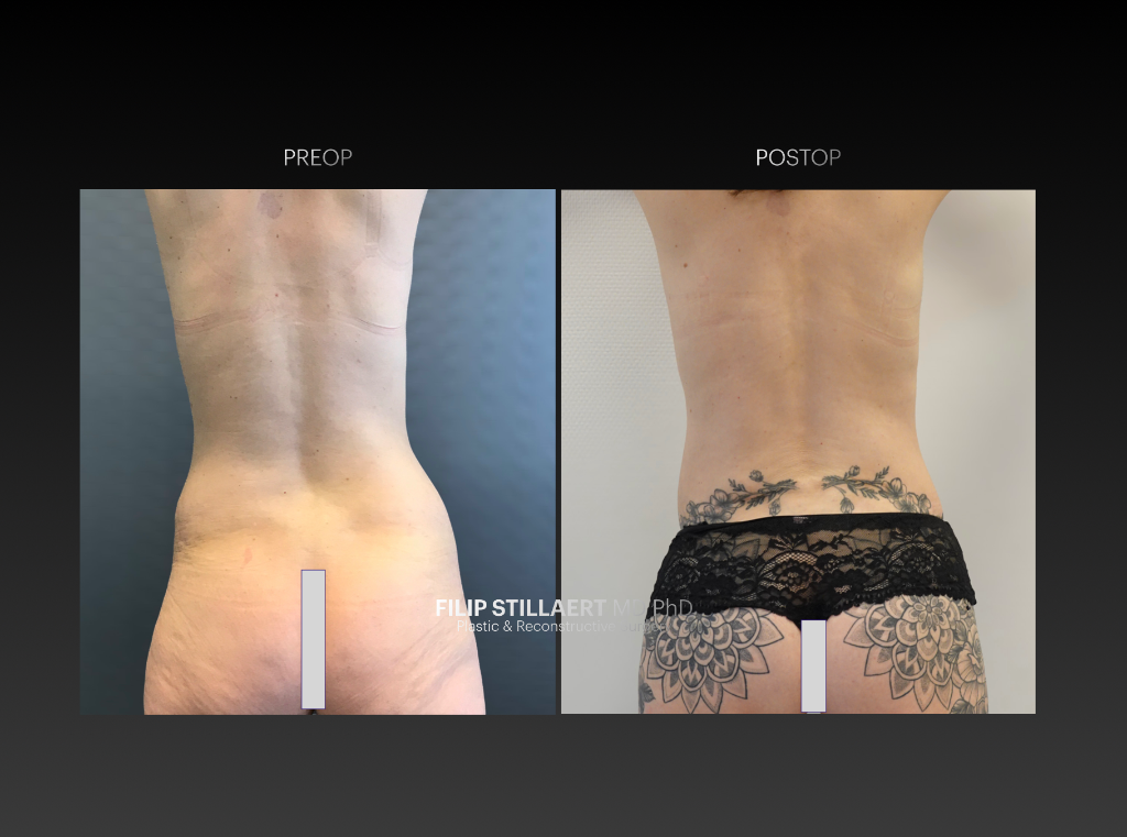 lumbar flap