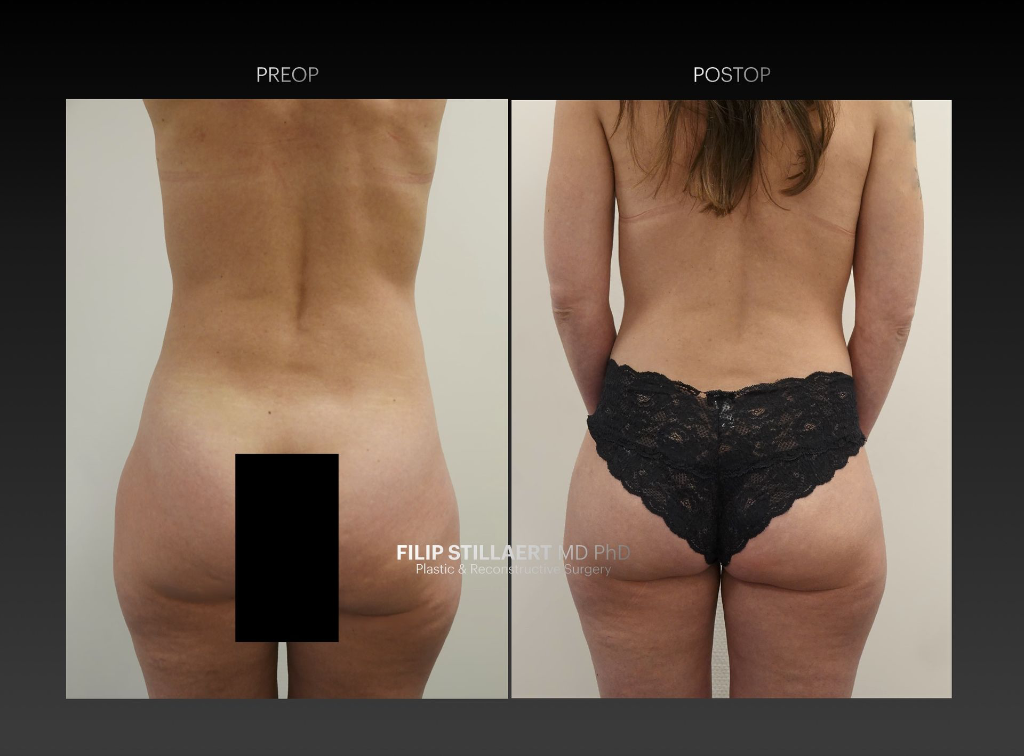 sgap flap