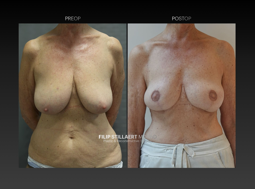 sgap flap