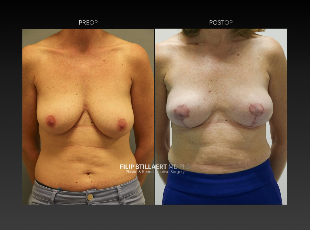 sgap flap