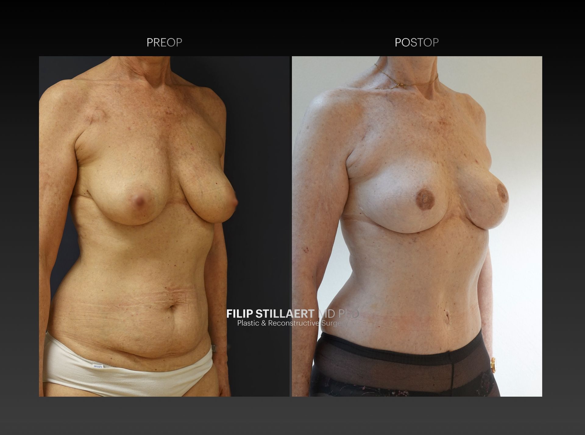 diep flap