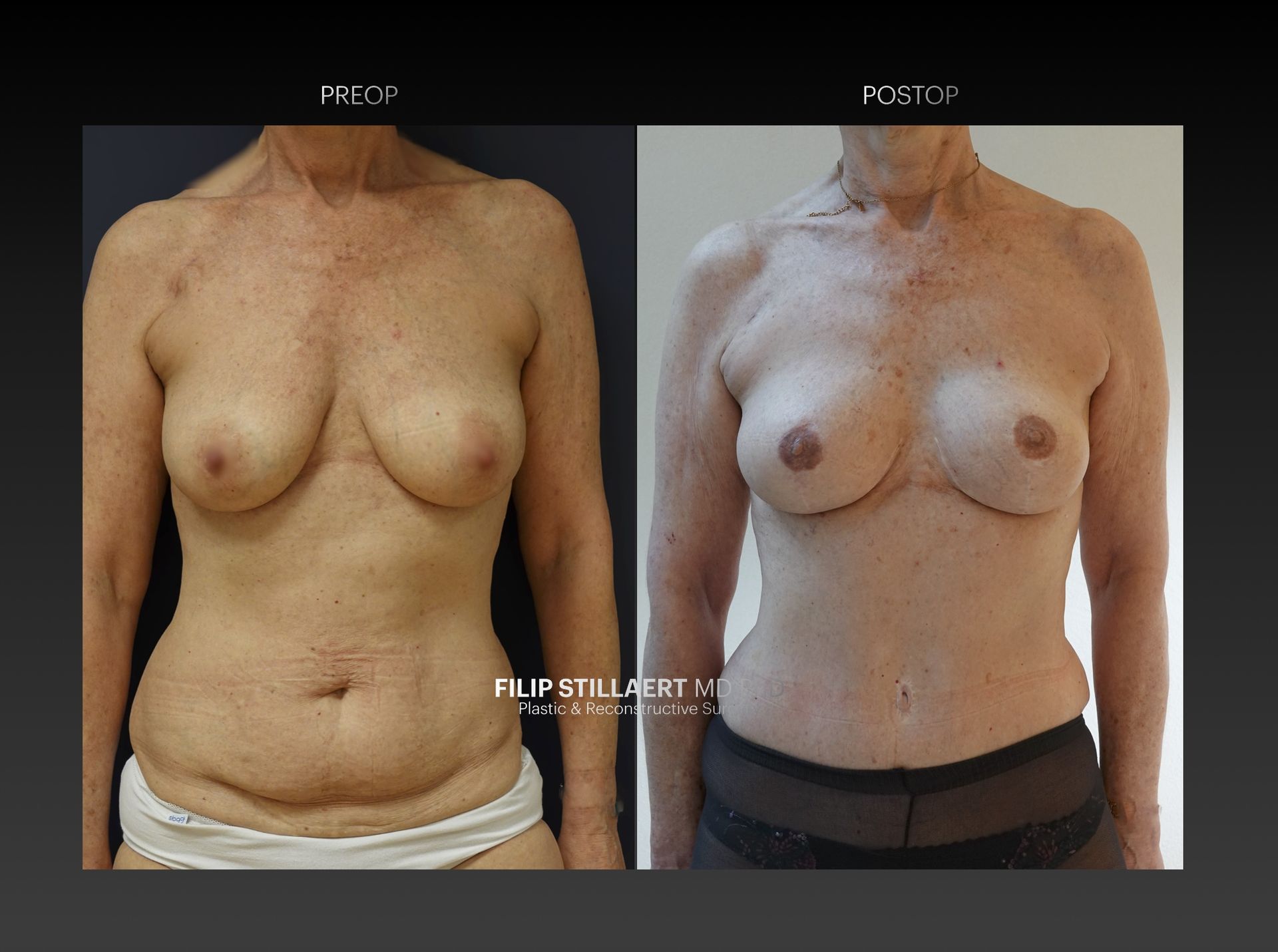 diep flap