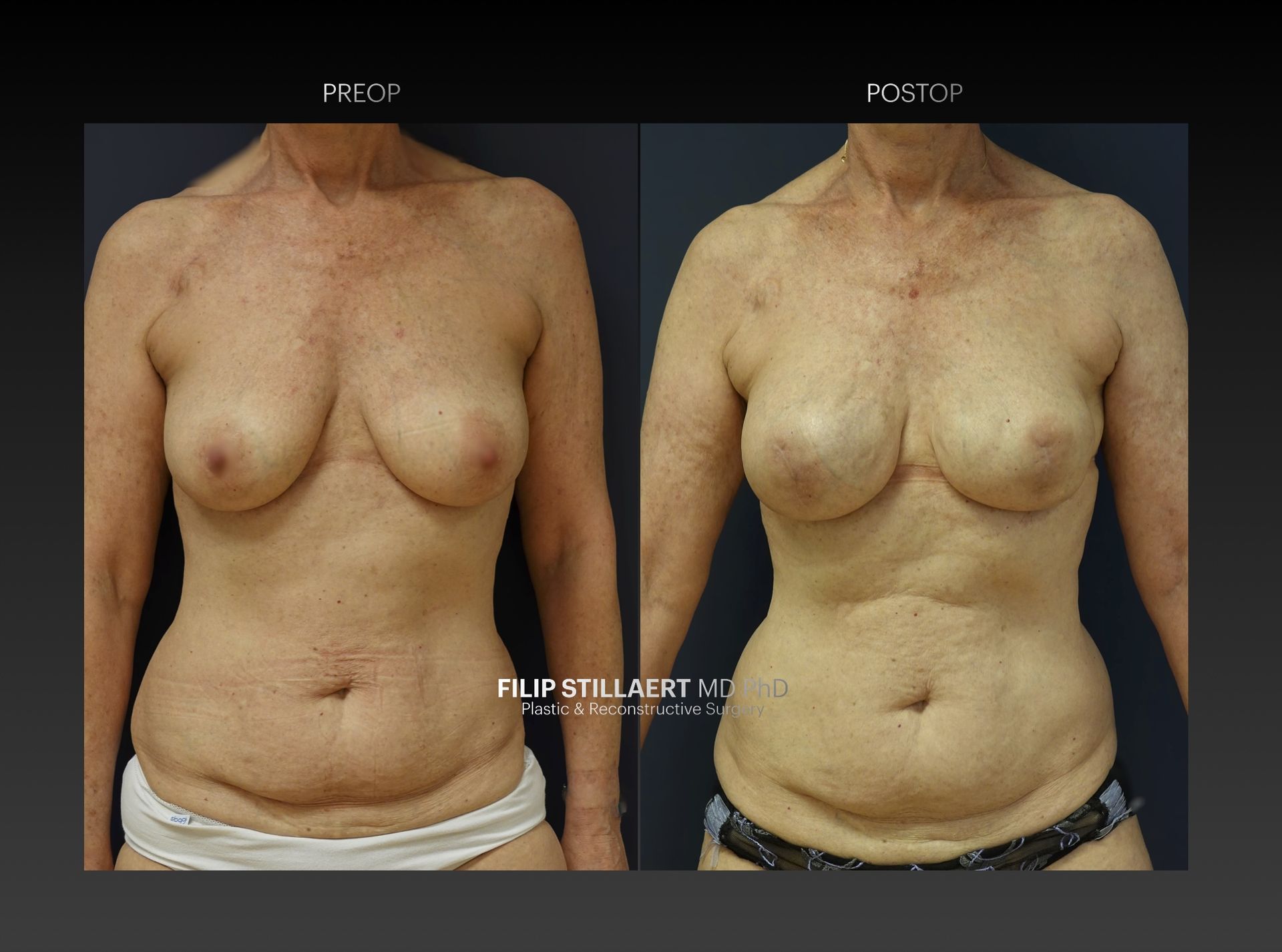 diep flap