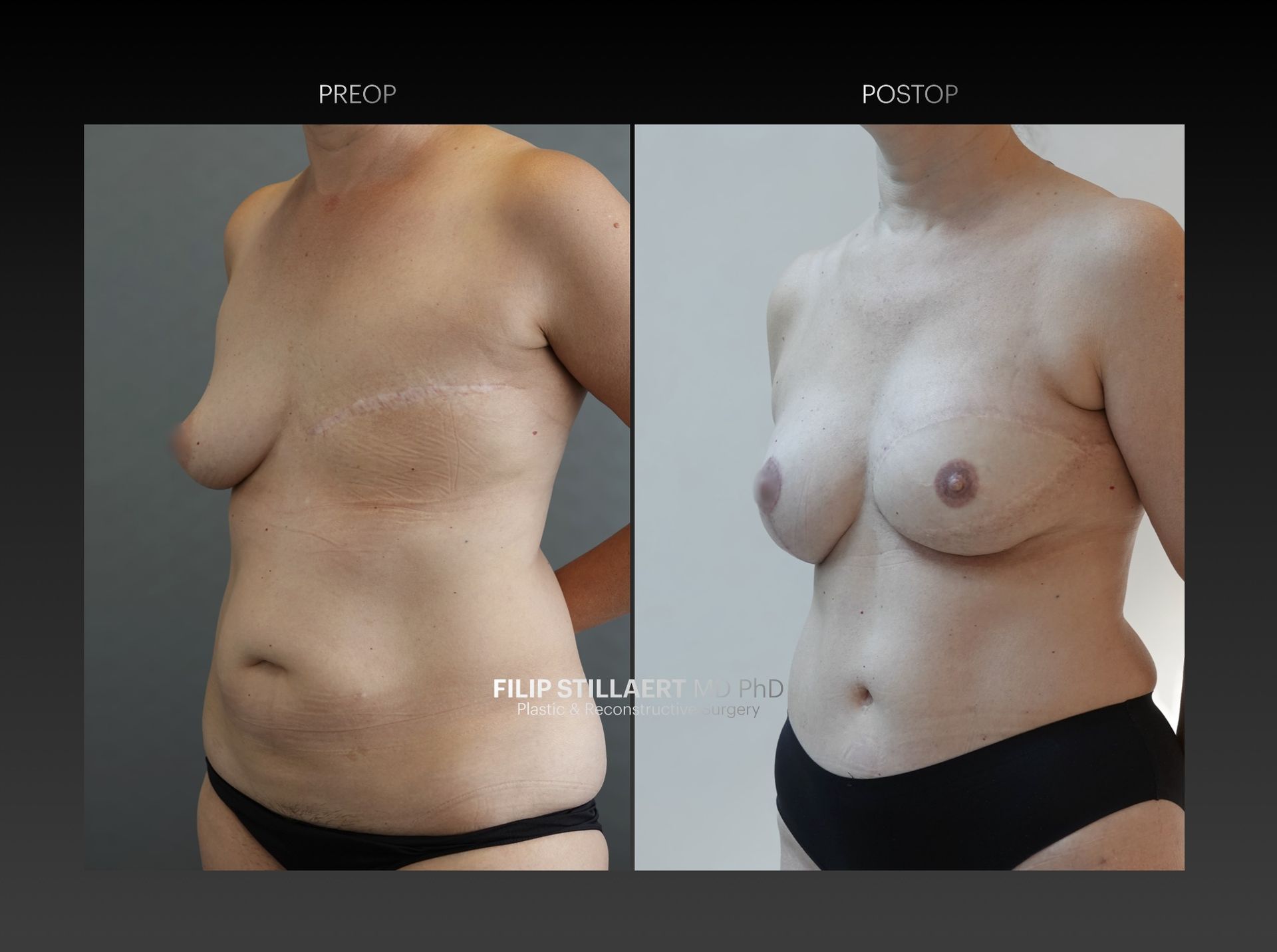 diep flap
