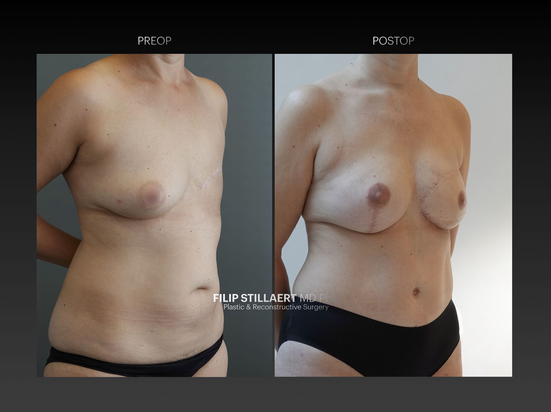 diep flap