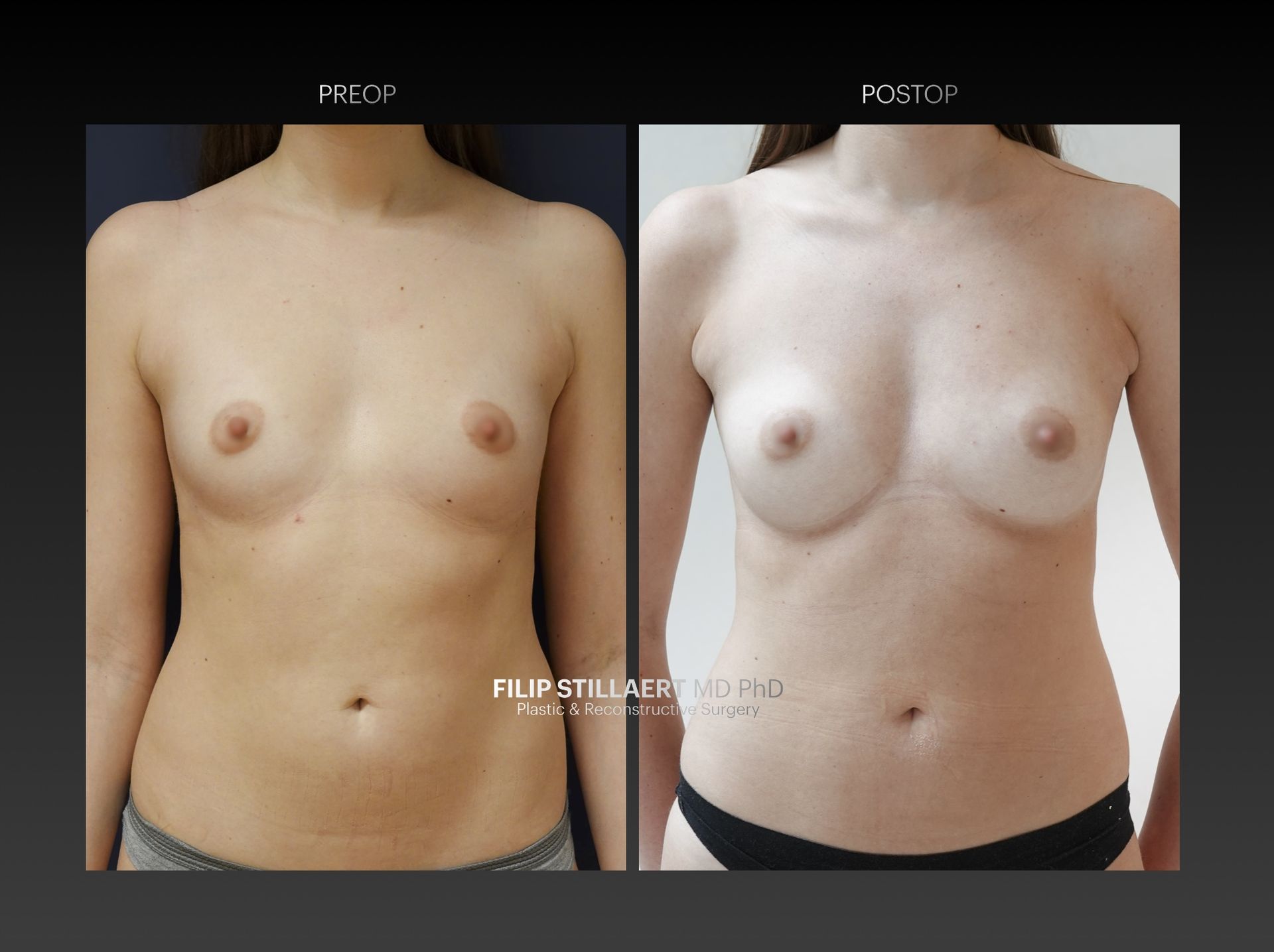 borstvergroting lipofilling