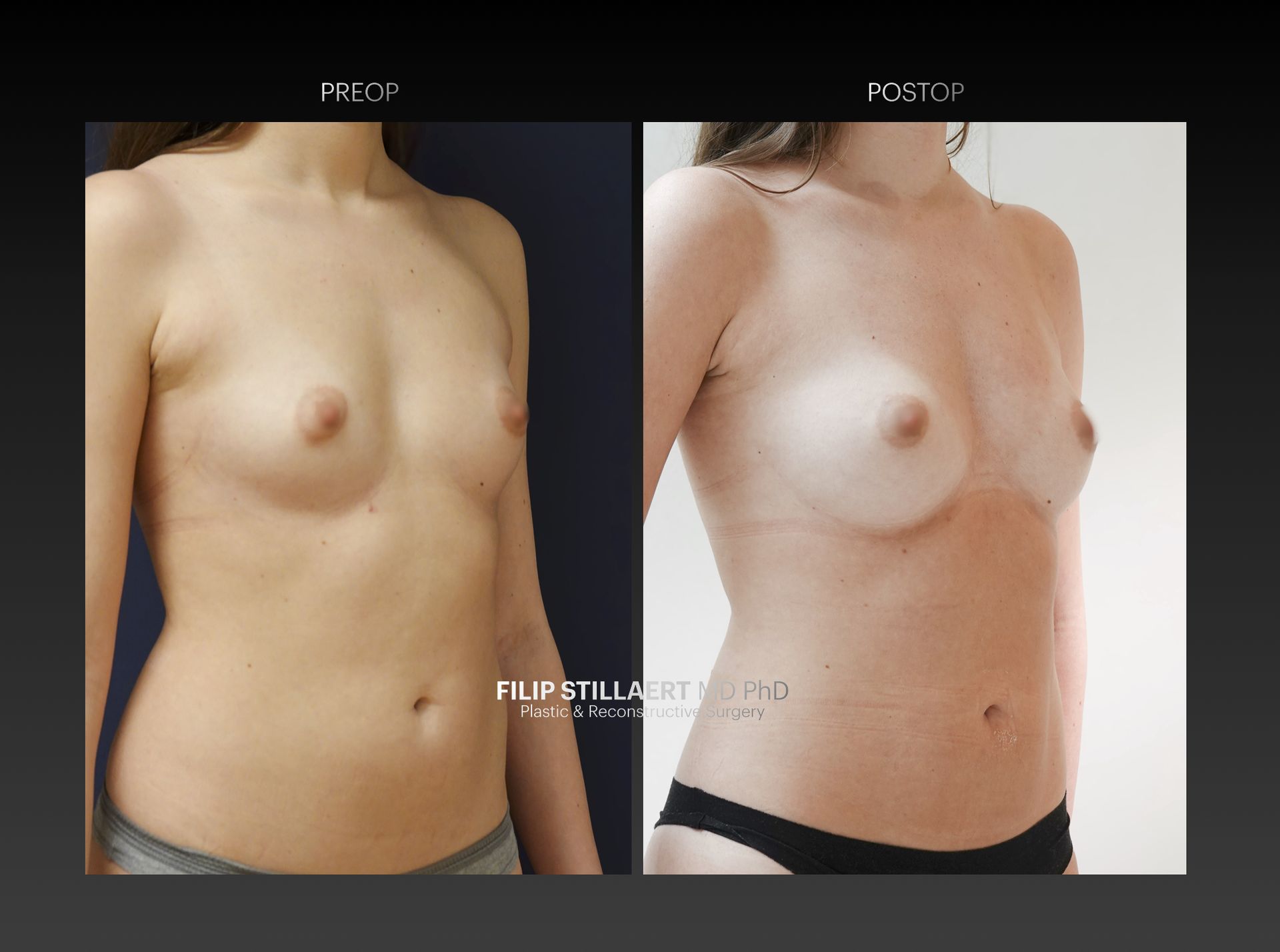 borstvergroting lipofilling