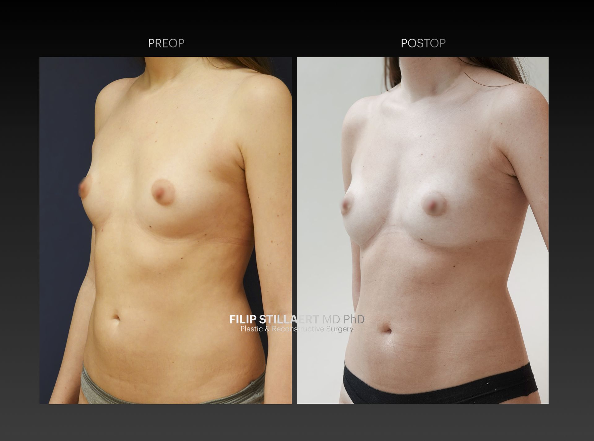 borstvergroting lipofilling