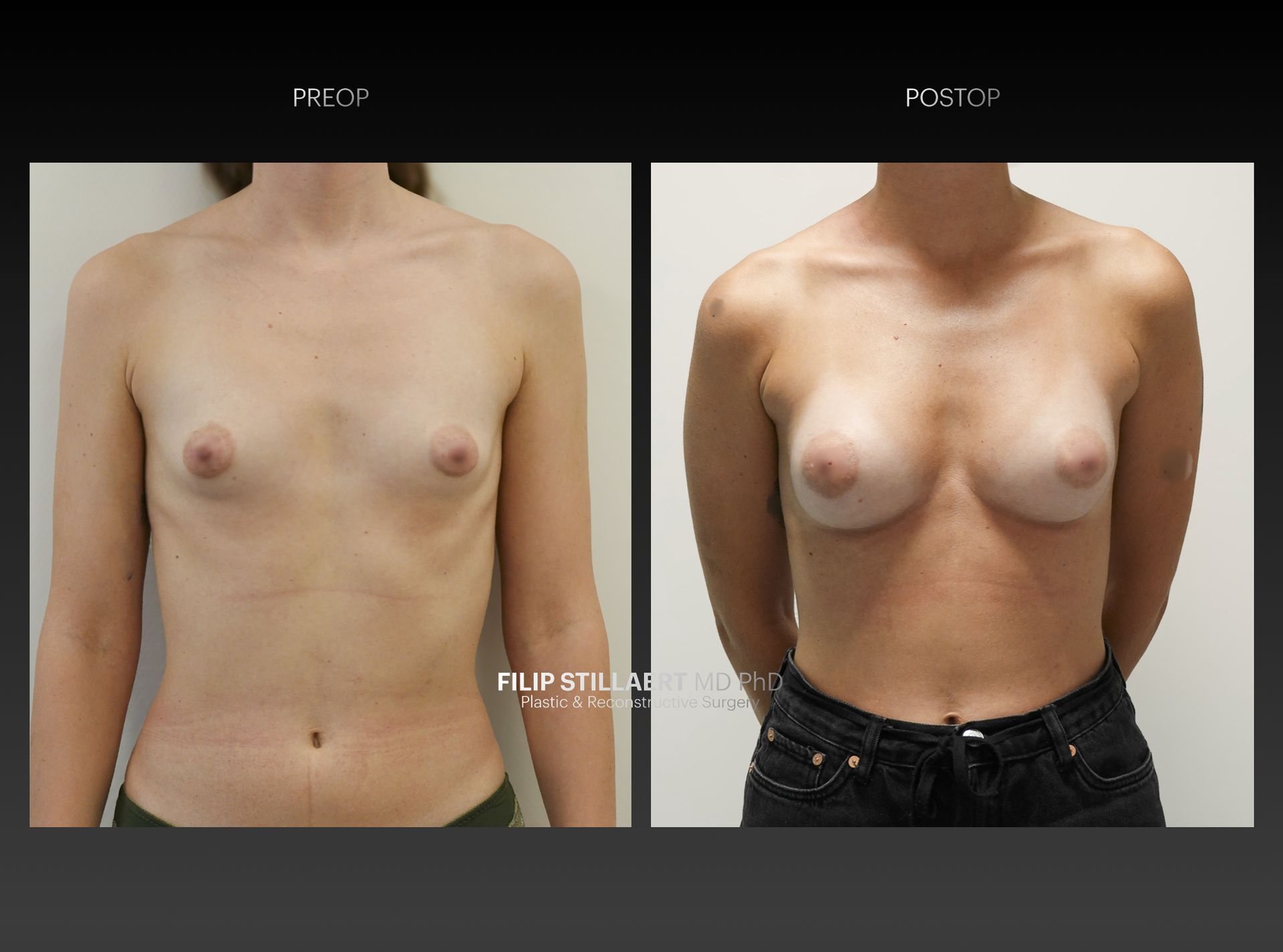 hybrid breast augmentation
