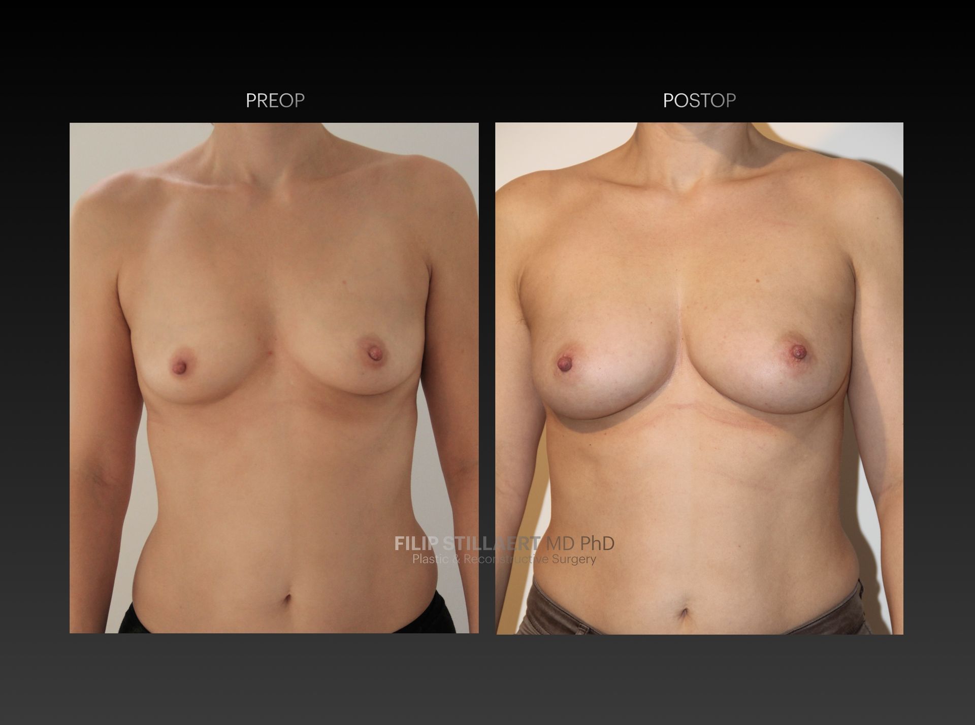 borstvergroting lipofilling