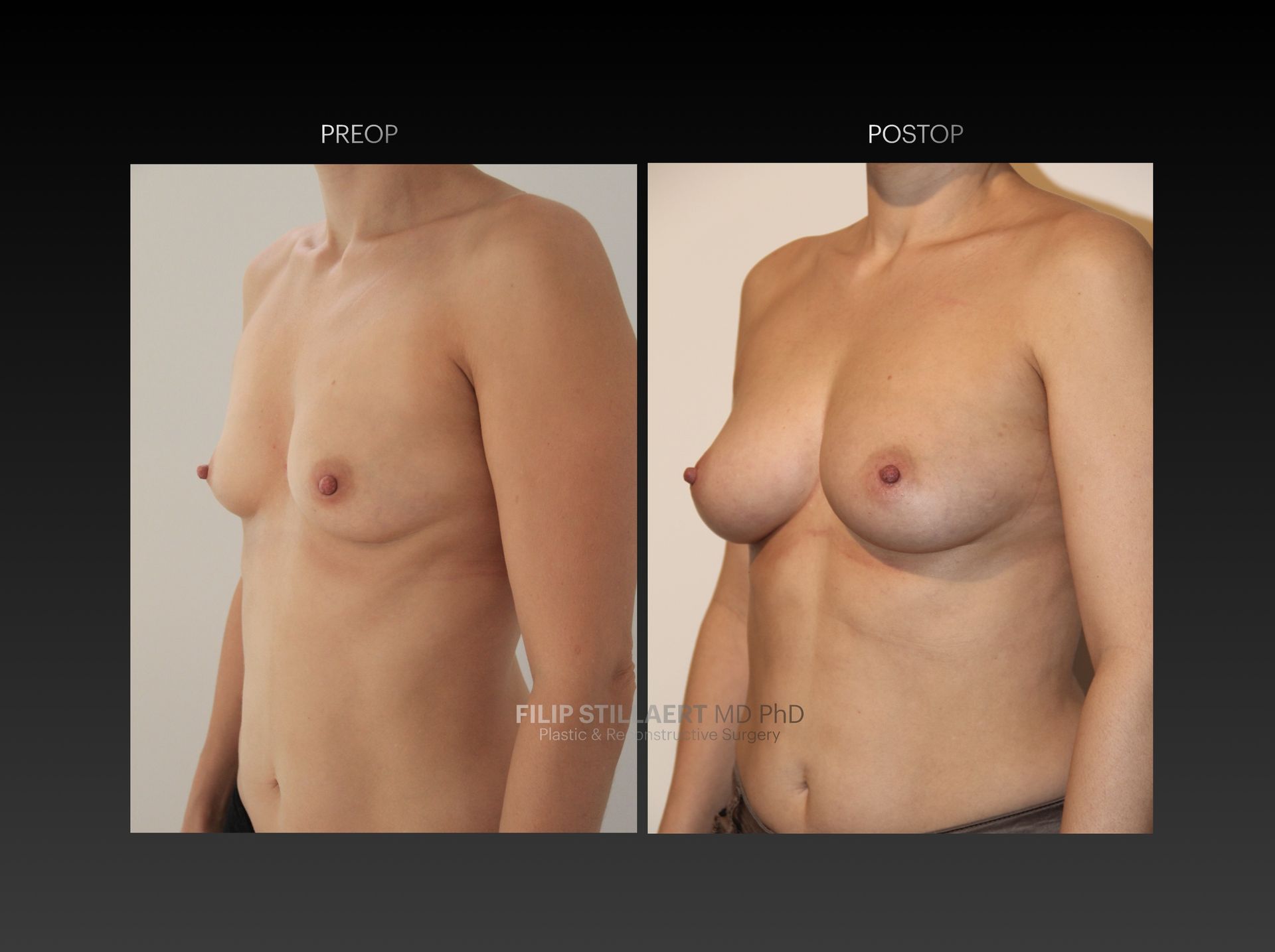 borstvergroting lipofilling
