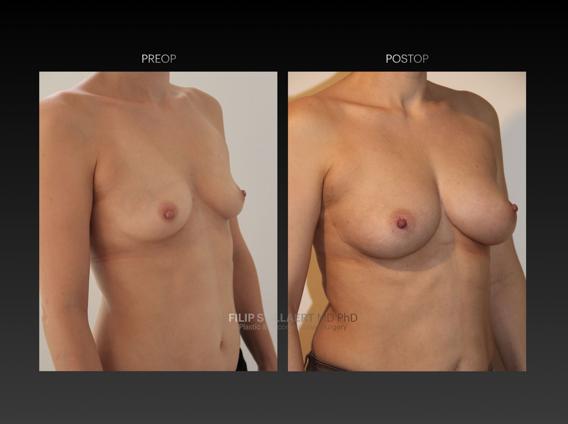 borstvergroting lipofilling
