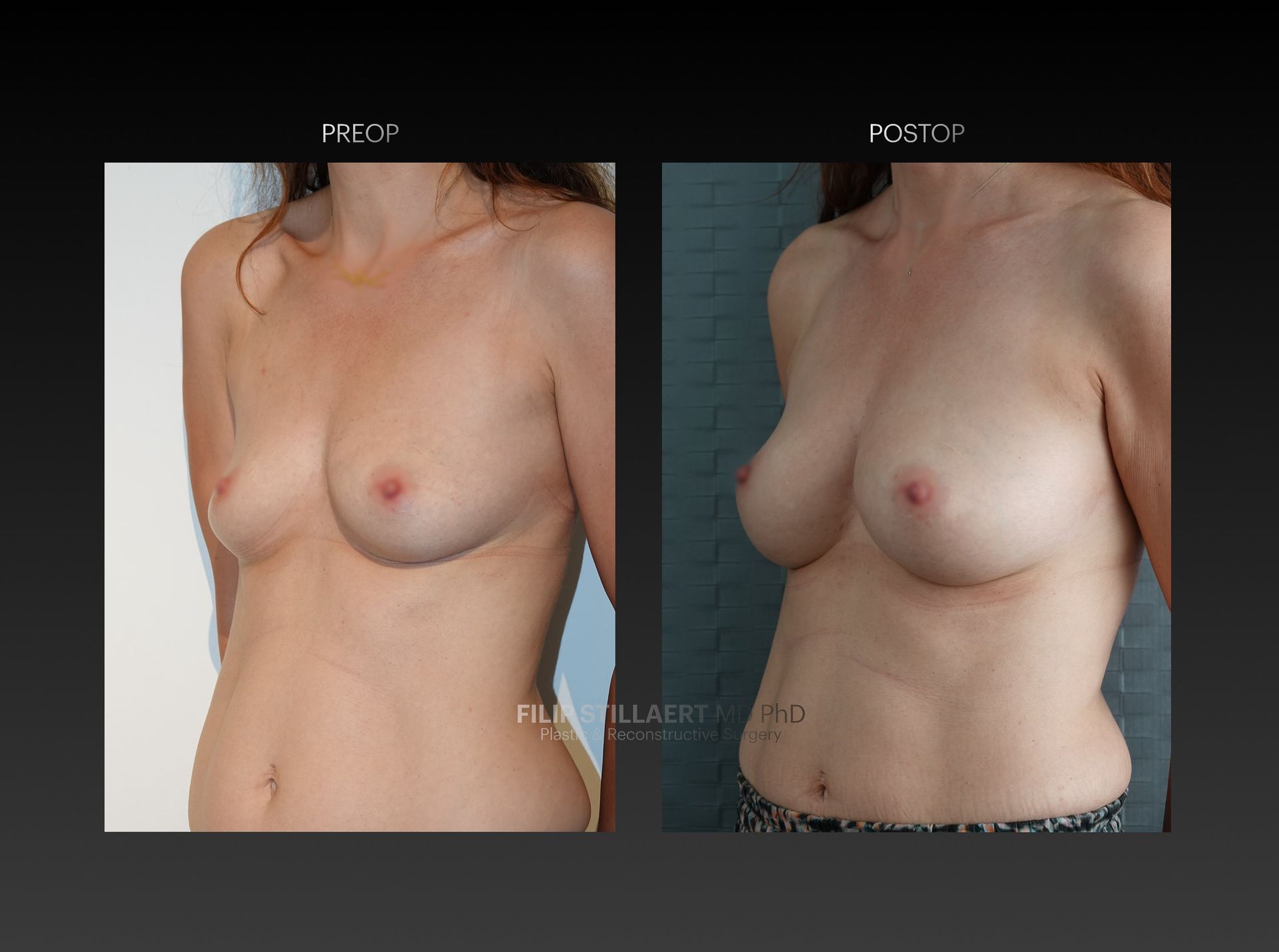 borstvergroting lipofilling