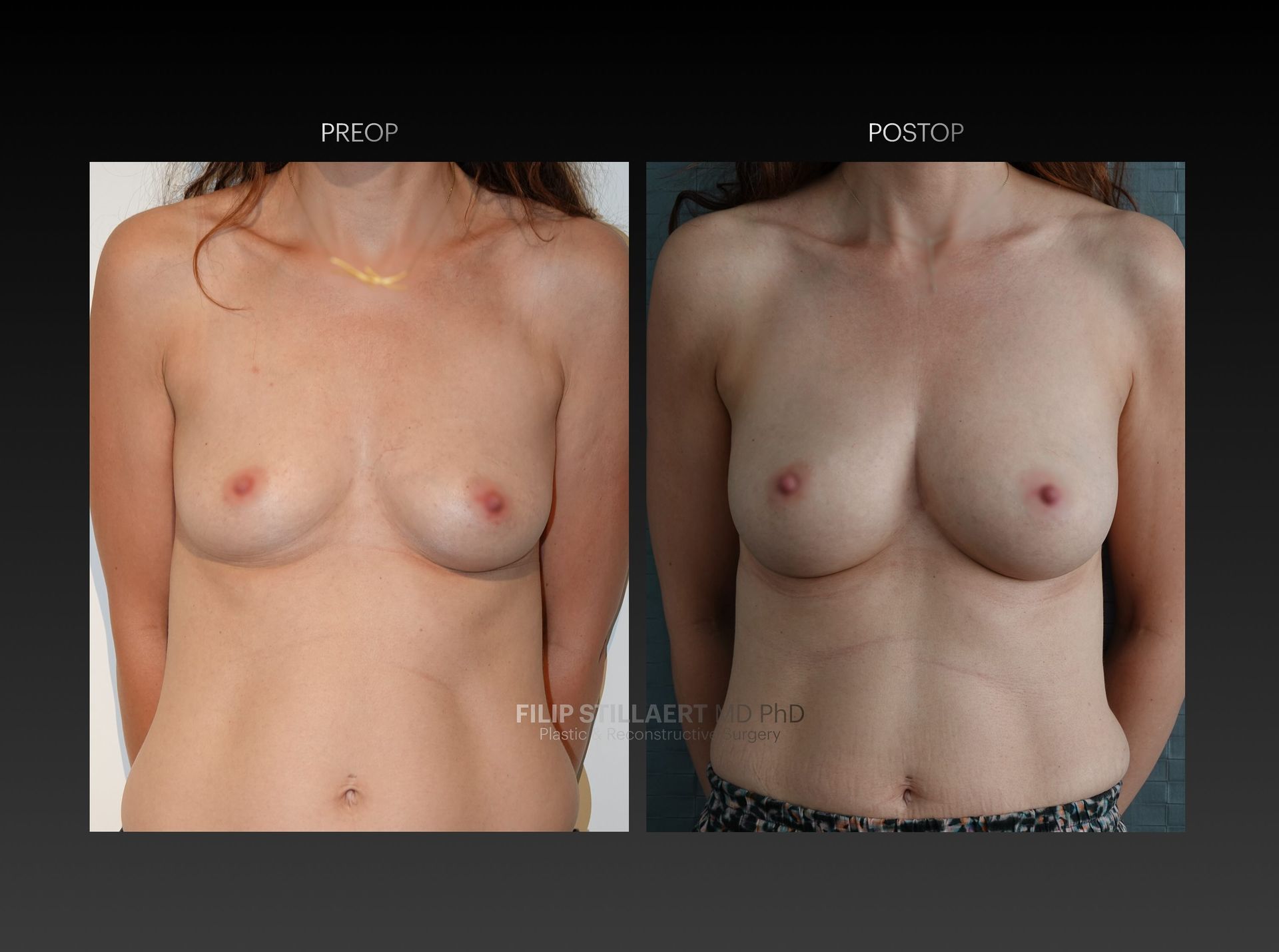 borstvergroting lipofilling