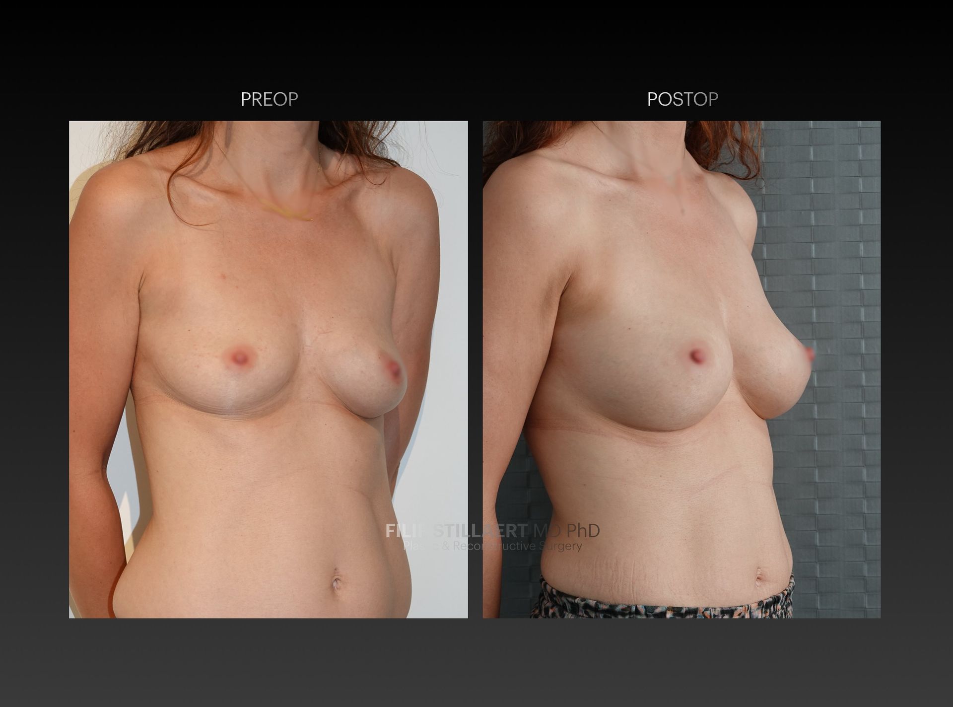 borstvergroting lipofilling
