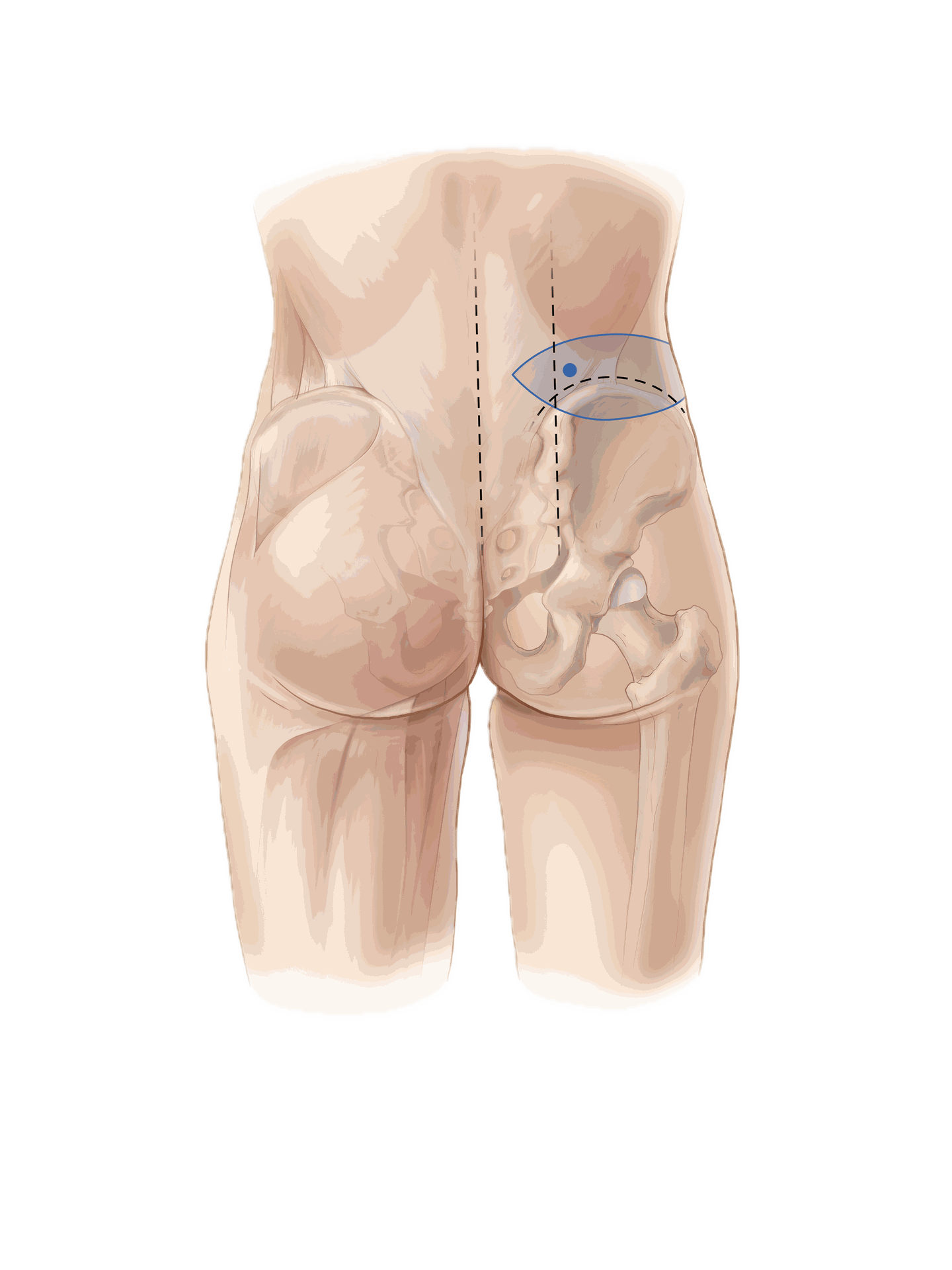 lumbar flap