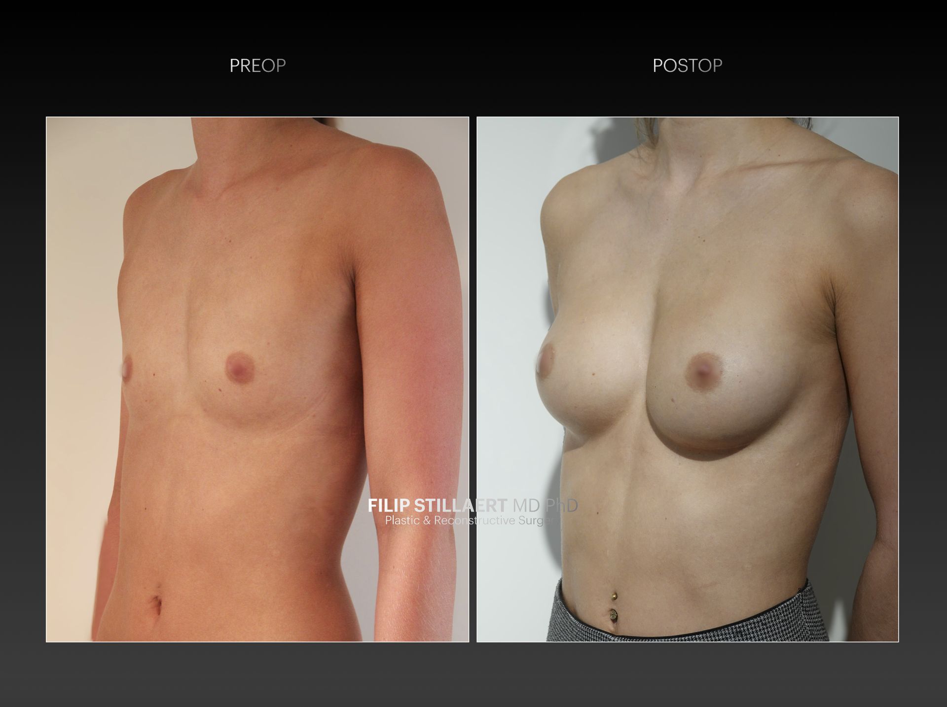 natuurlijke borstvergroting