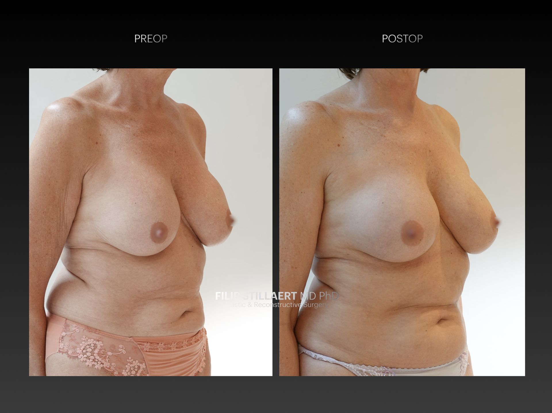 explantatie prothesen