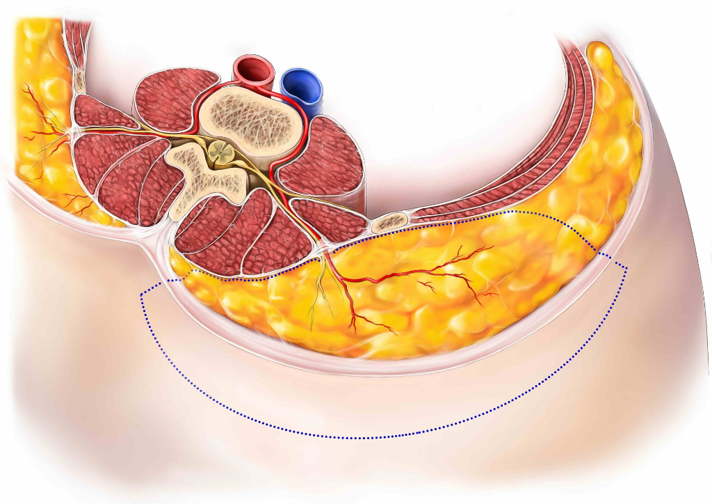 lumbar flap