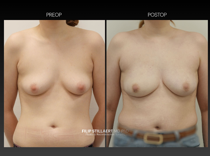 hybrid breast reconstruction
