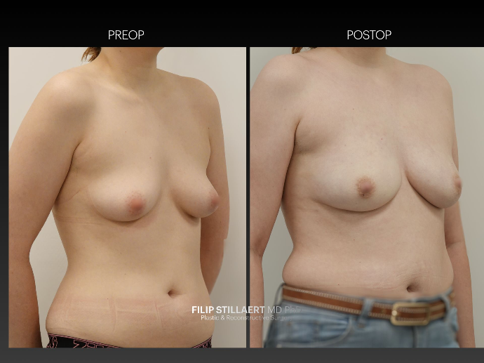 hybrid breast reconstruction