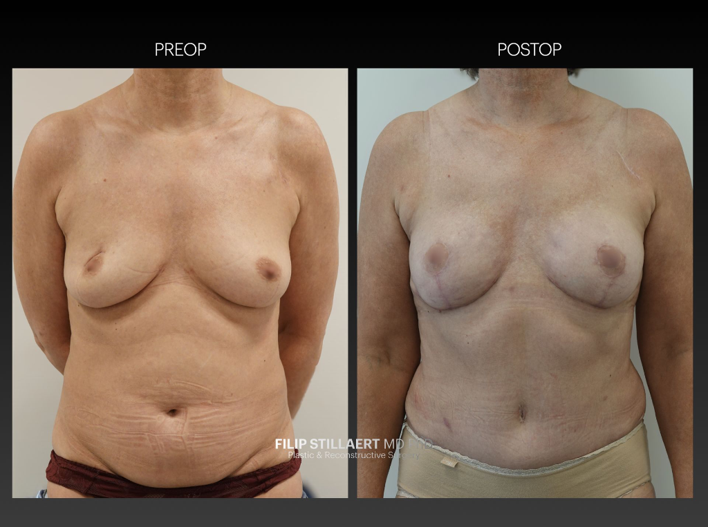 diep flap
