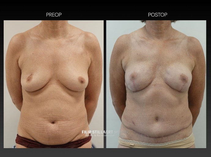 diep flap