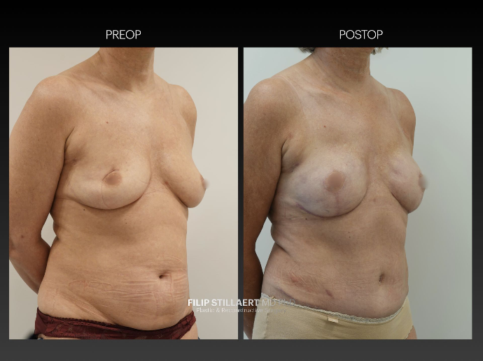 diep flap