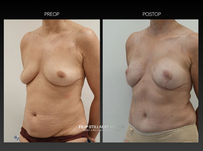 diep flap
